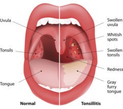 Seven valuable approaches when you have a sore throat