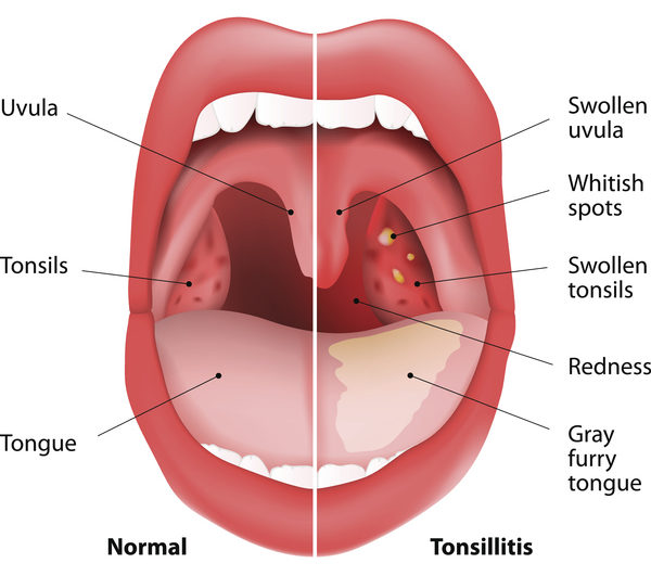 Tonsillitis bacterial