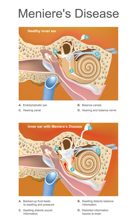 Meniere disease. Illustration. Disorder of the inner ear that can effect hearing and balance to a varying degree.