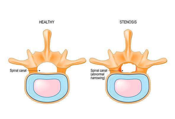 Lumbar Spinal Stenosis is an abnormal narrowing in spinal canal.