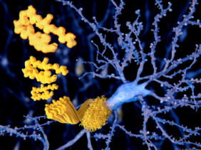 The beta amyloid peptid, amyloid plaques, Alzheimer disease
