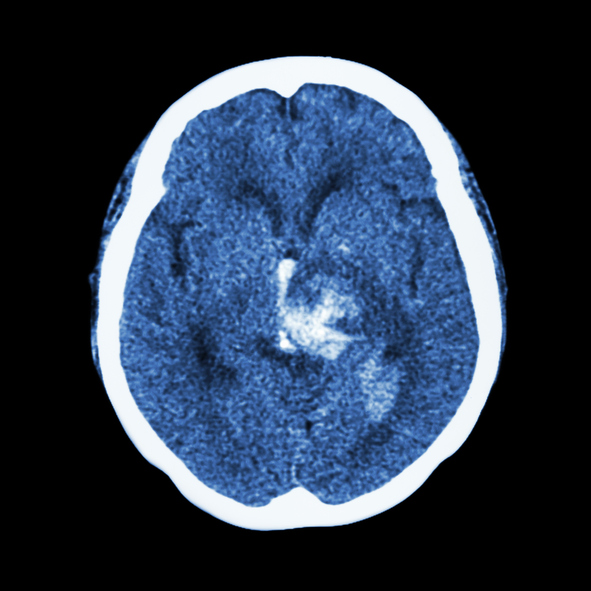 CT scan of brain : show hemorrhagic stroke