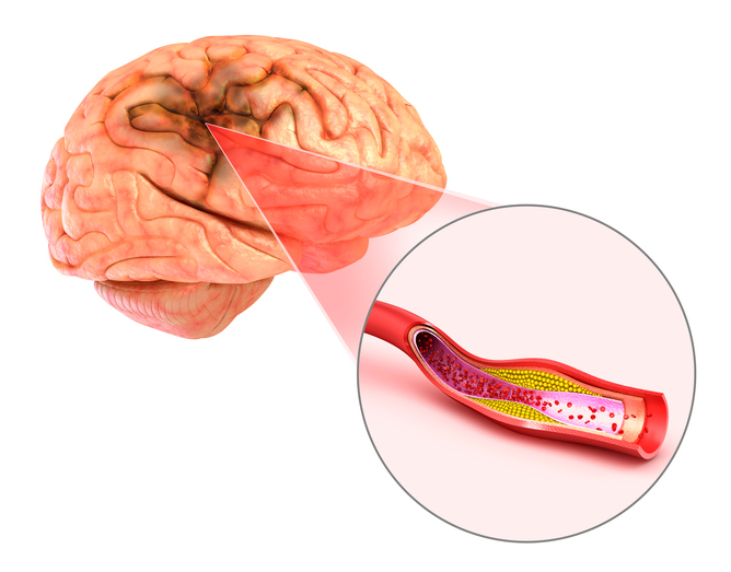 Brain stroke : 3d illustration of the vessels of the brain and causes of stroke