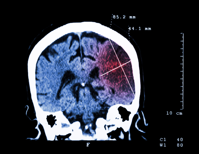 Cerebral infarction at left hemisphere ( Ischemic stroke )