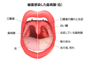 bacterial-tonsils