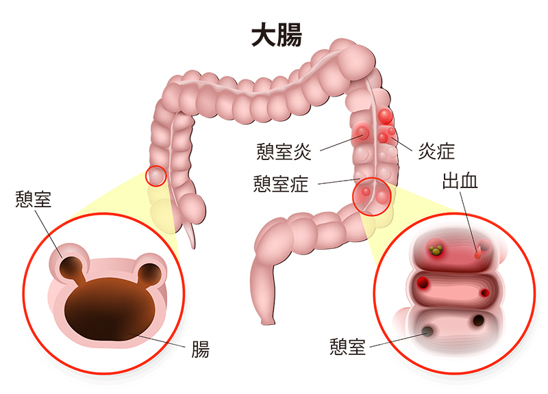 潰瘍性大腸炎の原因と危険因子