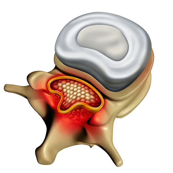 Spinal Stenosis Concept