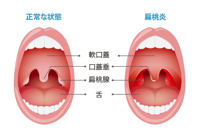 痰を伴う咳(湿性咳嗽)に対するアーユルヴェーダ医学