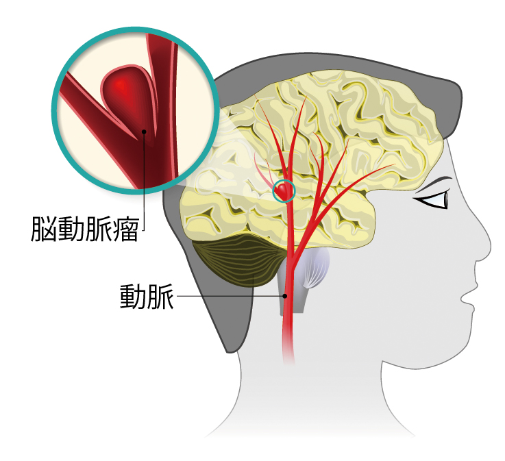 brain-aneurysm