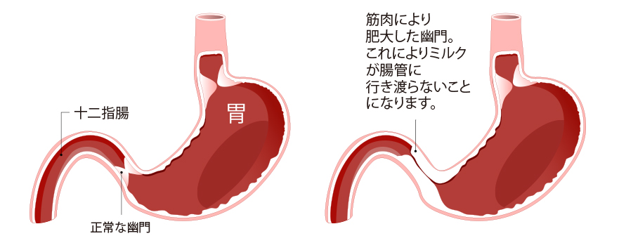 幽門狭窄の原因と危険因子