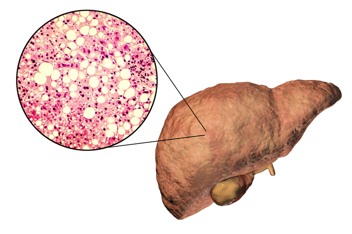 Fatty liver, liver steatosis