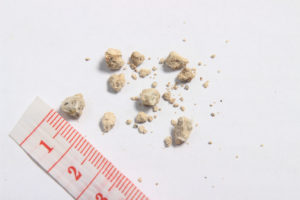 flat lay or top view very small kidney stones with ruler at white background