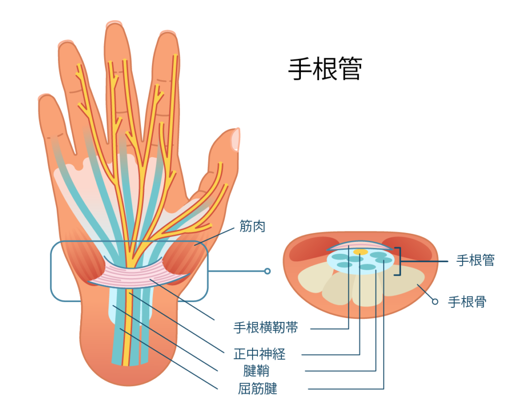  Carpal tunnel syndrome