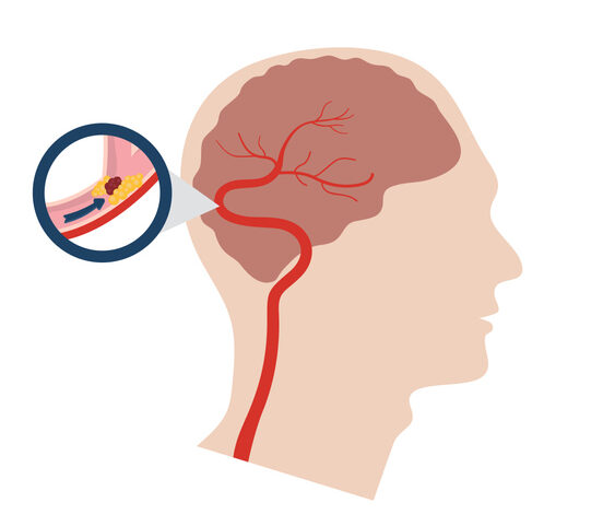 Vector illustration of a stroke