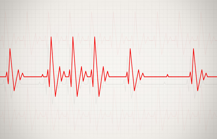 Irregular Heartbeat Illustration