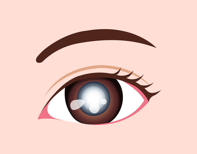 Eye disease vector illustration / Cataract